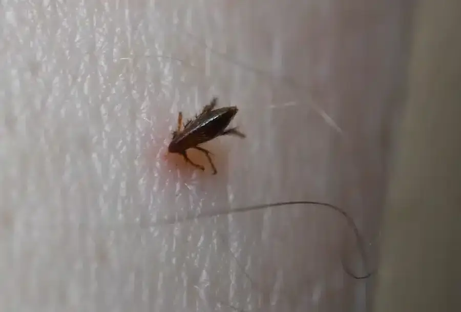 Flea on human skin showing bite reaction