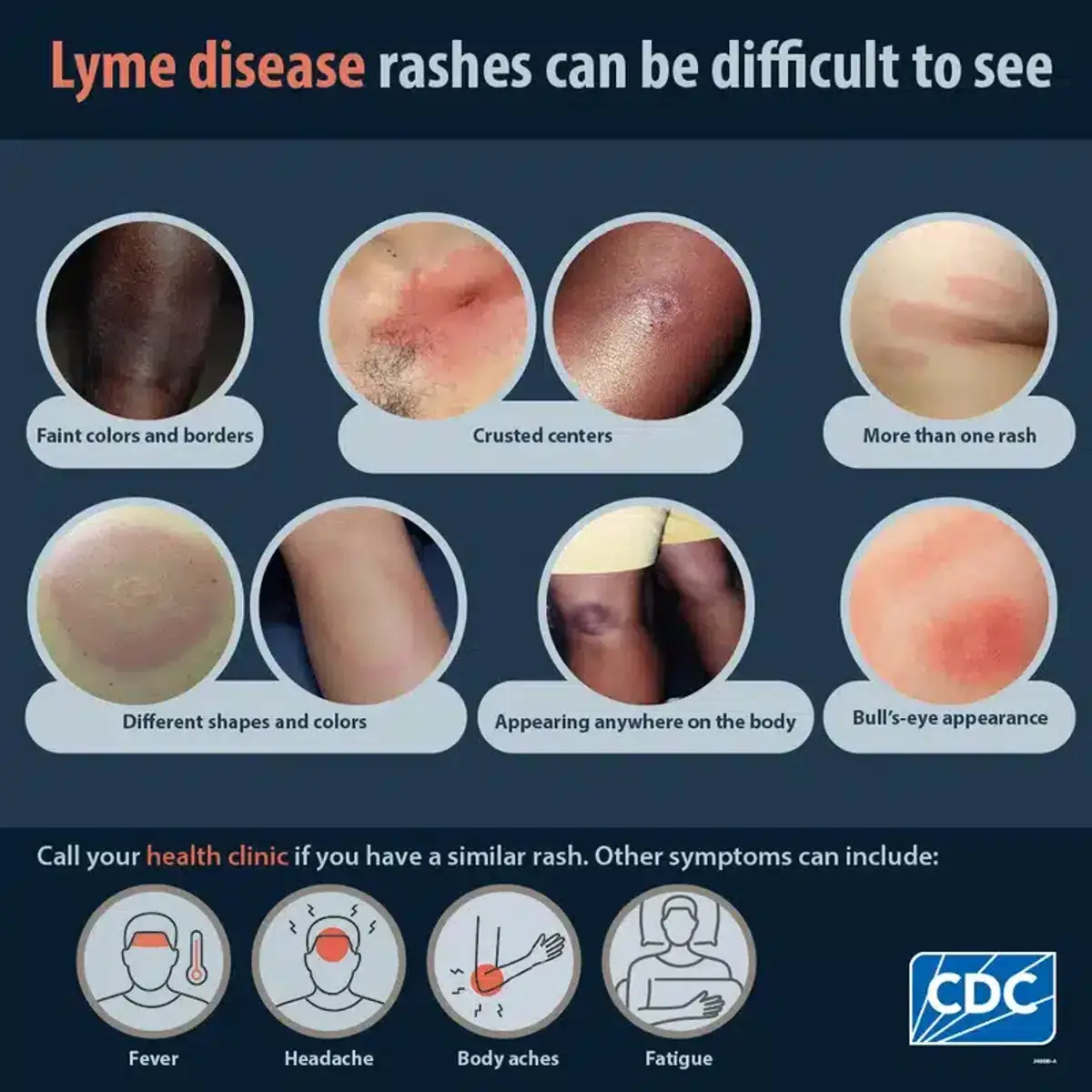 Different types of Lyme disease rashes showing the bull's-eye pattern and variations