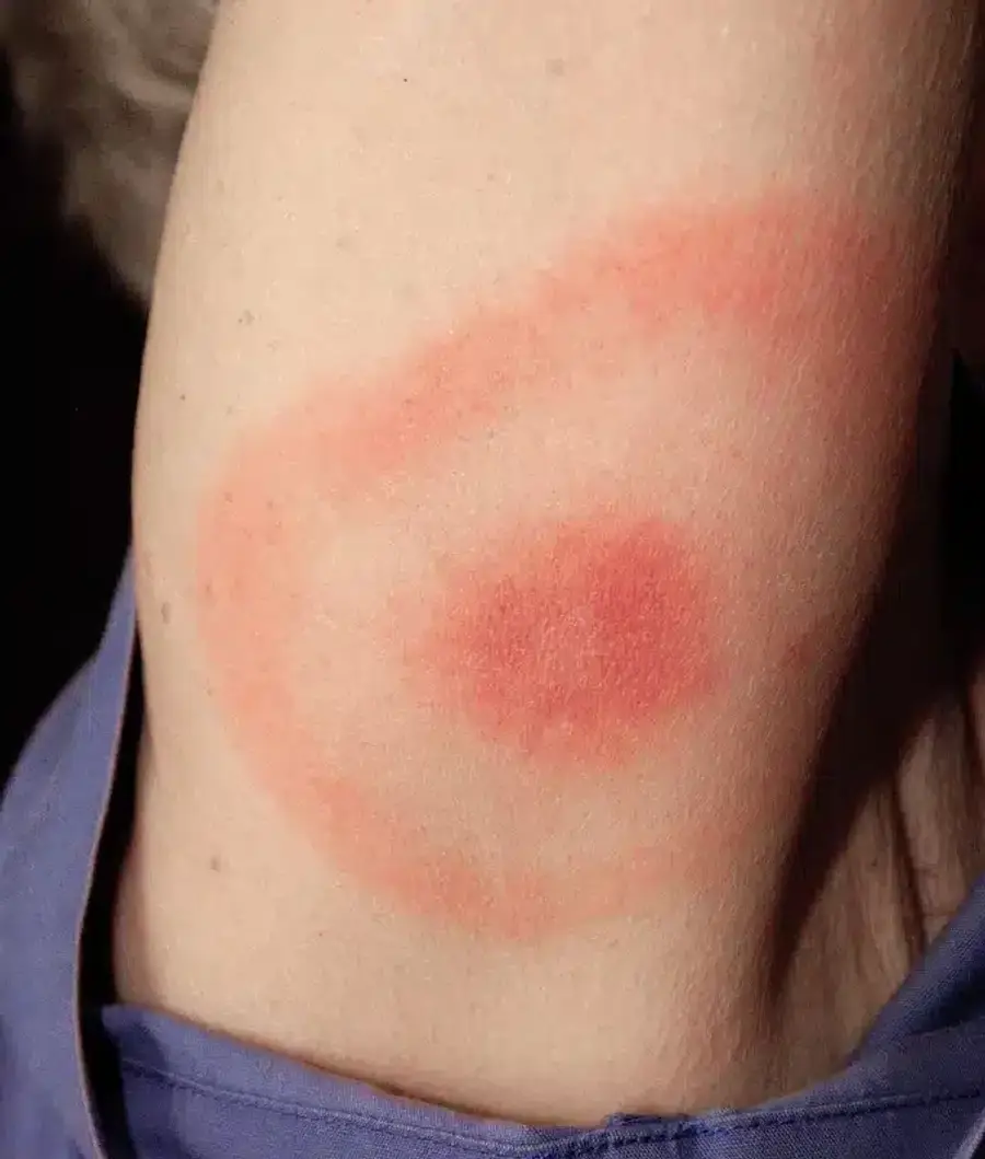 Red rash on skin