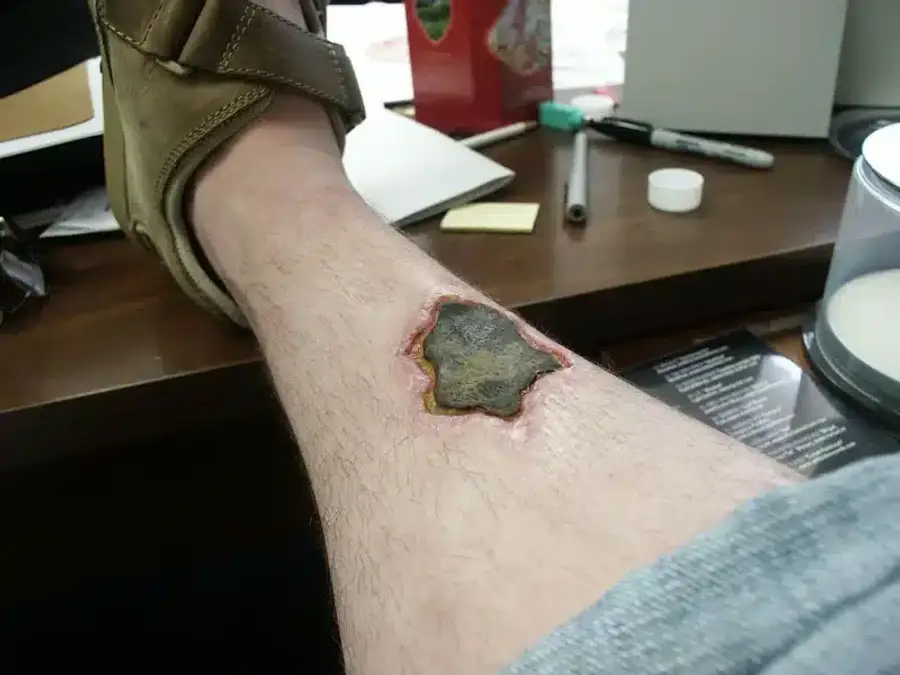 Infected skin injury on a leg.