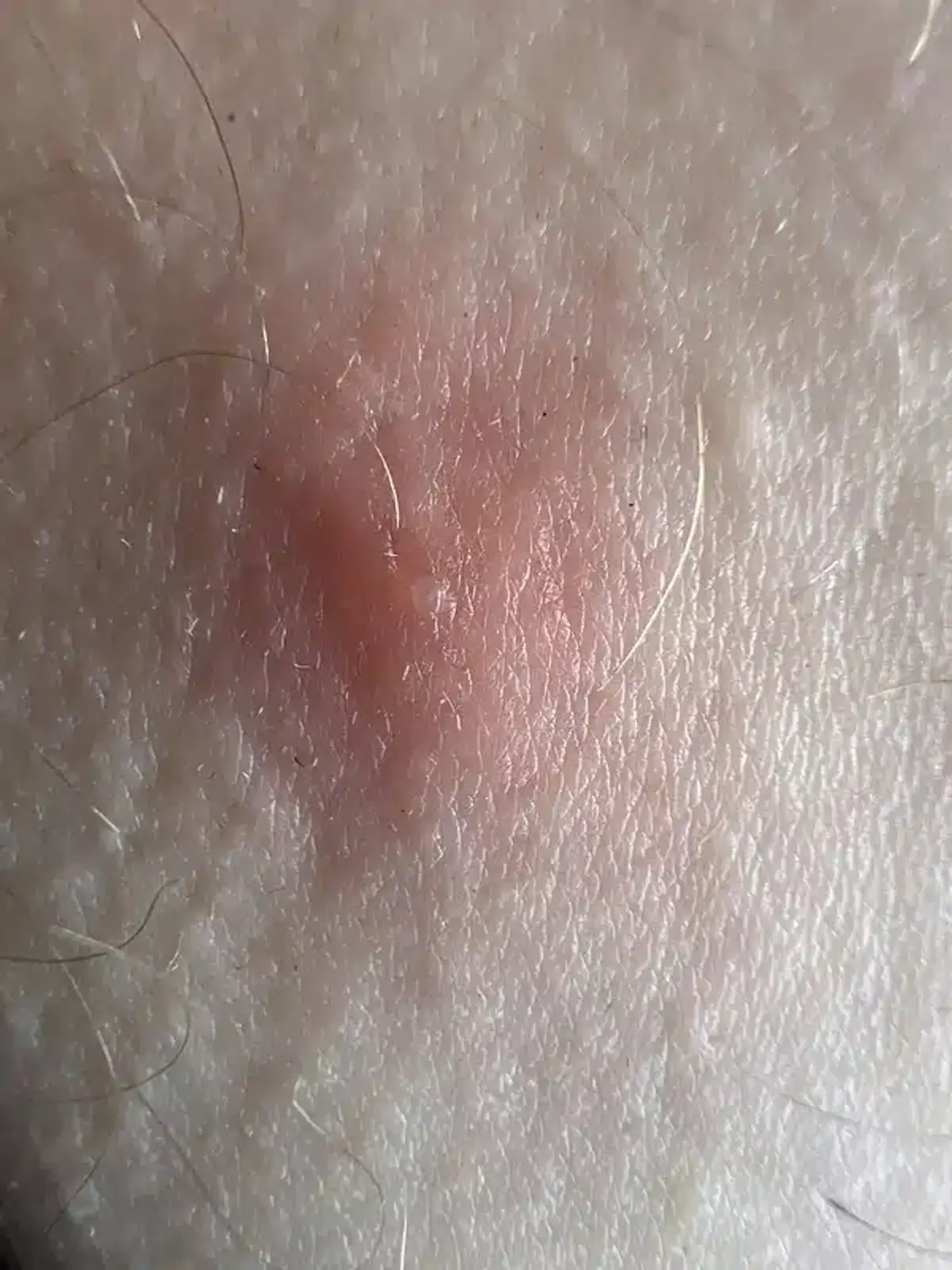 Close-up of irritated skin from chigger bite reaction