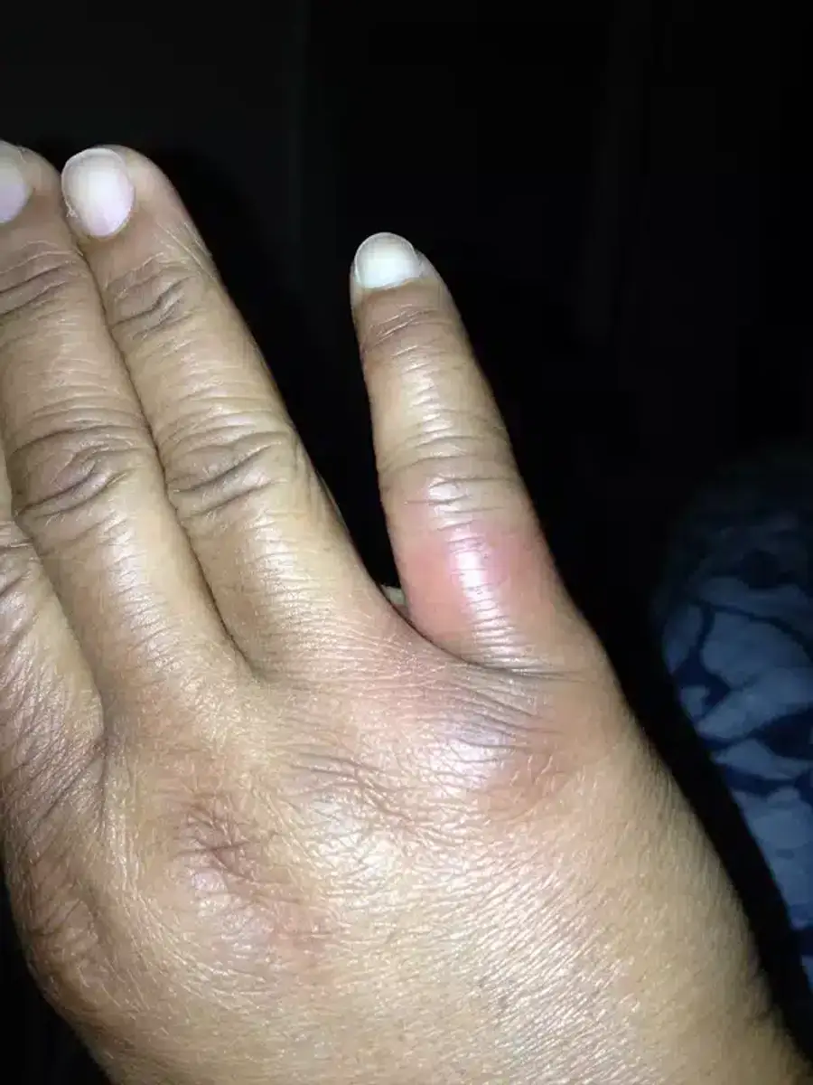 Swollen finger on a hand