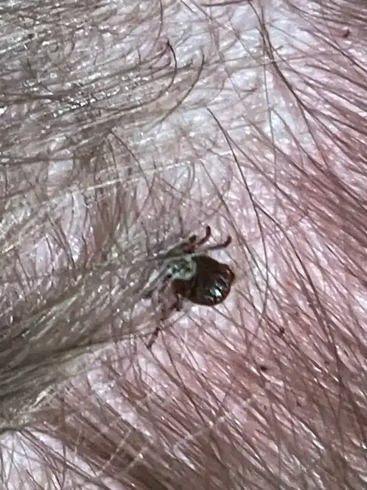 Tick found in hair showing typical attachment location