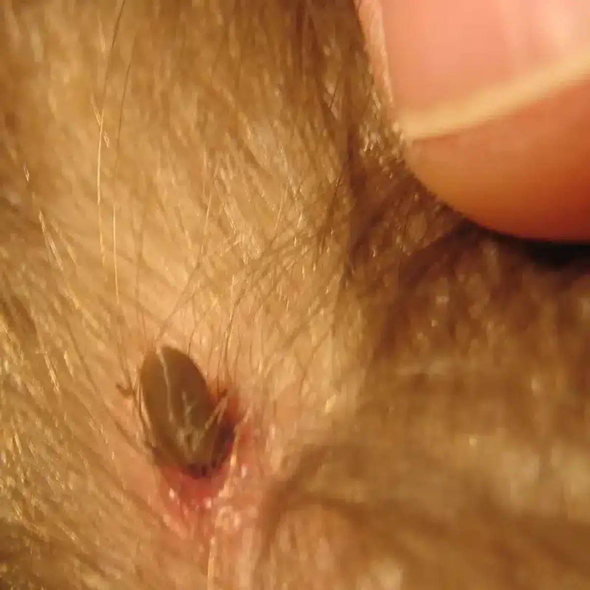 A tick attached to human skin before removal