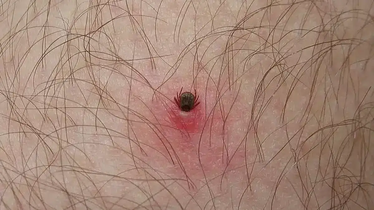 Tick bite on human skin