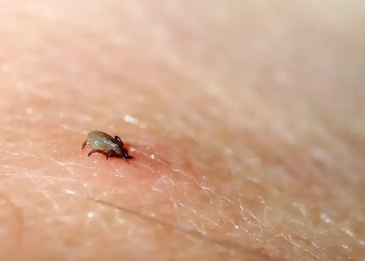 Close-up of a tick attached to human skin showing how it embeds