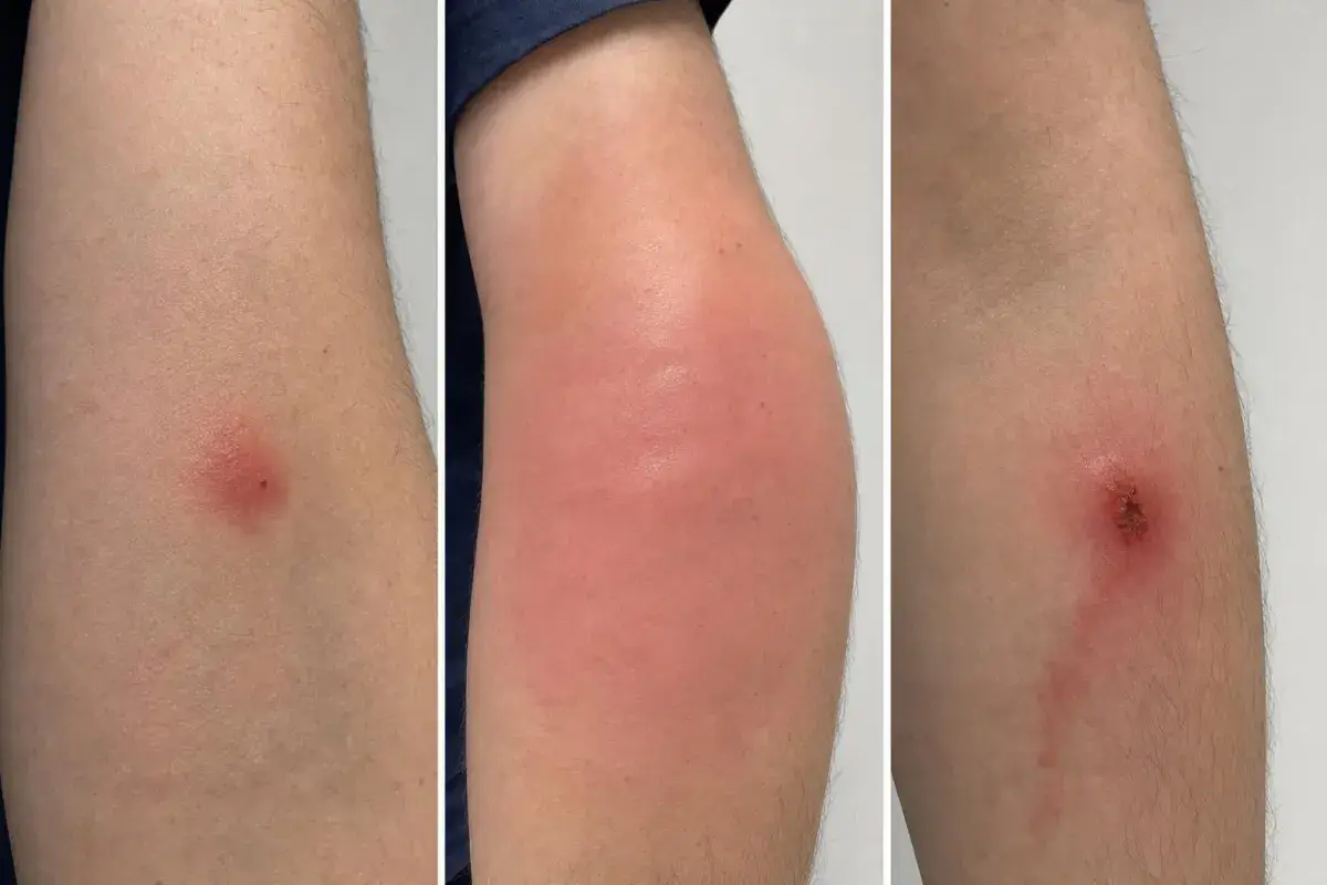 Three forearms side by side: a small red sting bump, a large puffy swelling, and a sting spot with a crust and a faint red streak