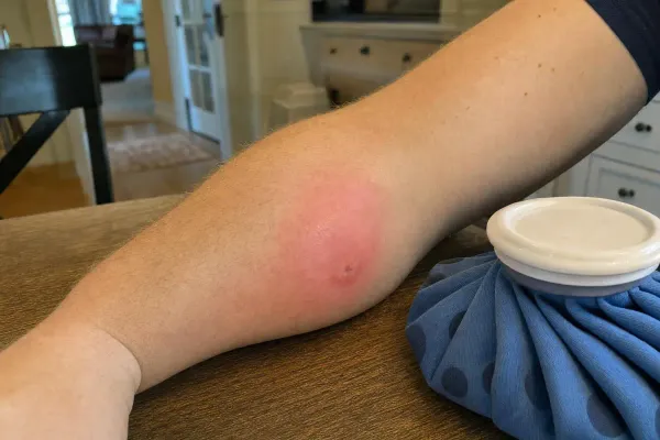 Wasp Sting Swelling After 48 Hours: Is It Normal?